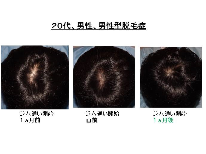 円形脱毛症　病院""